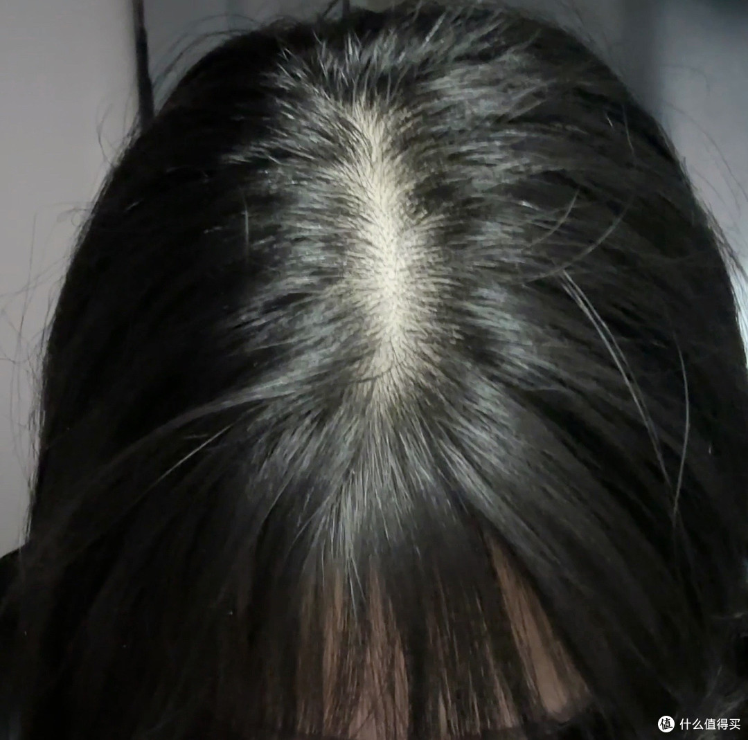 同头不同命：后脑勺这圈头发，还够不够植一次？