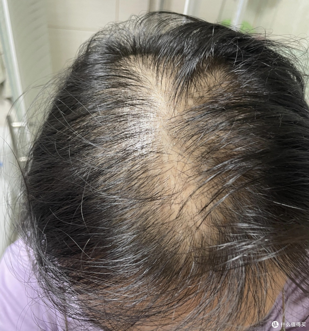 同头不同命：后脑勺这圈头发，还够不够植一次？