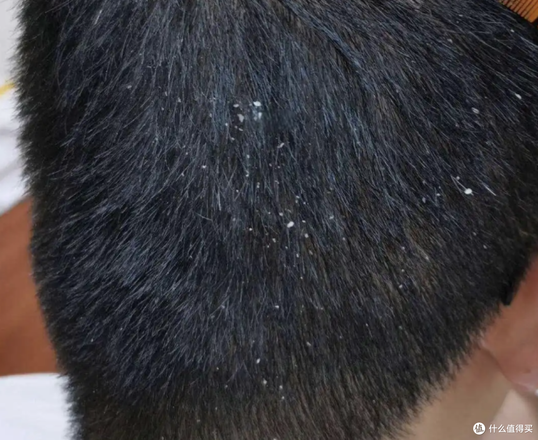头皮与发根特写：扒开看一眼，先分清类型