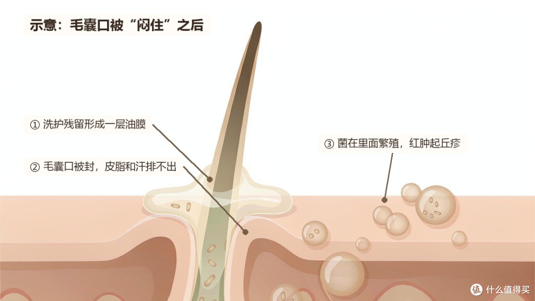 残留物怎么把毛囊口“闷住”
