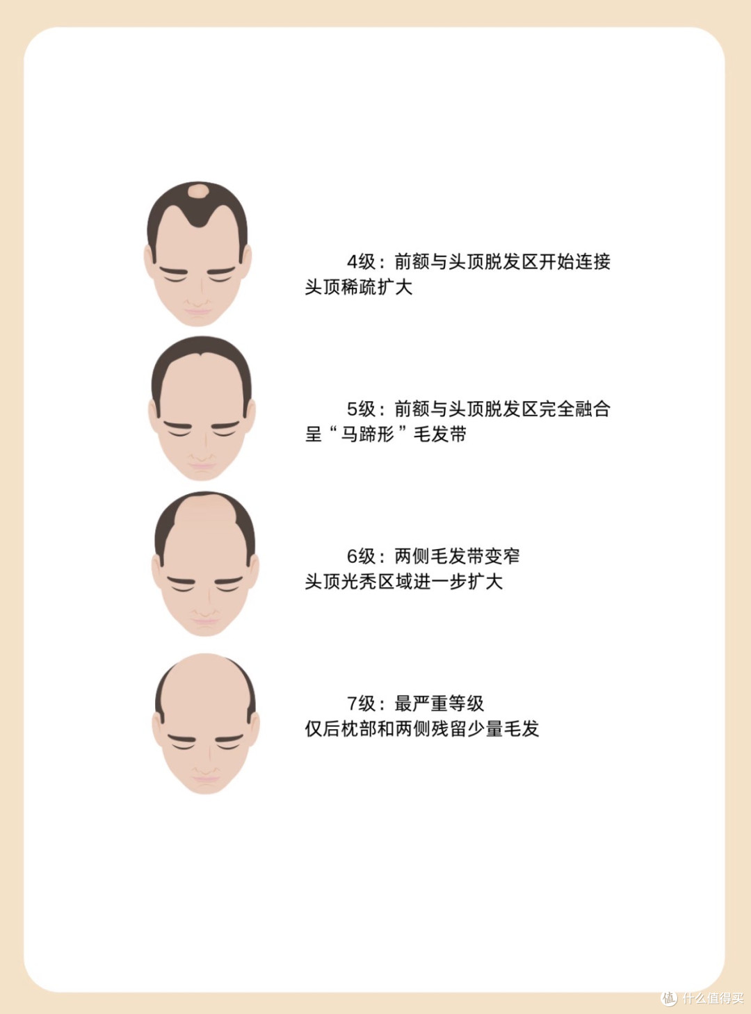 植发都用上机器人了,男生发际线后移还有救吗?