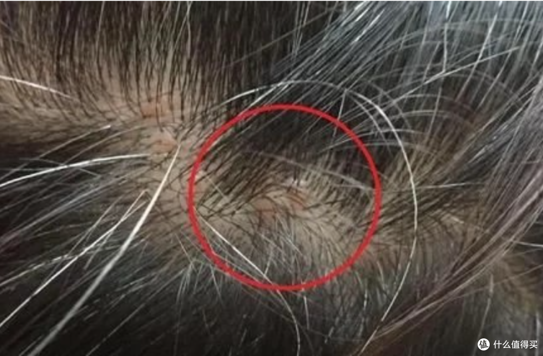 头上突然冒出小疙瘩?千万别用手抠!越抠越秃,这不是危言耸听!