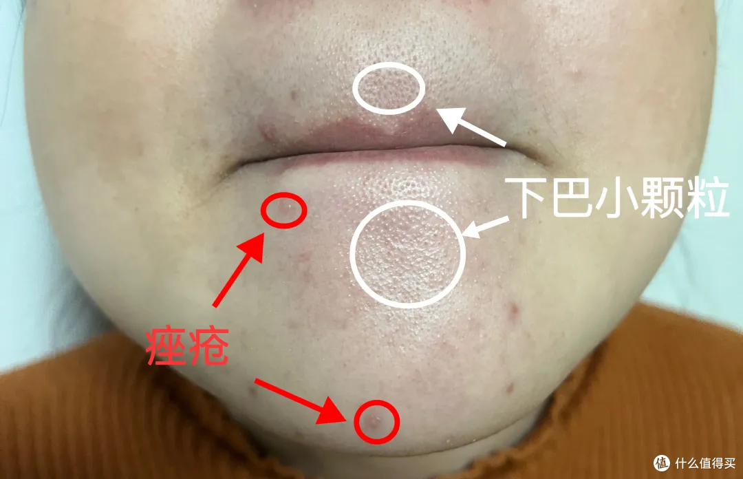 下巴上那层刺刺的小颗粒是啥?真不是闭口,别再上手抠了!