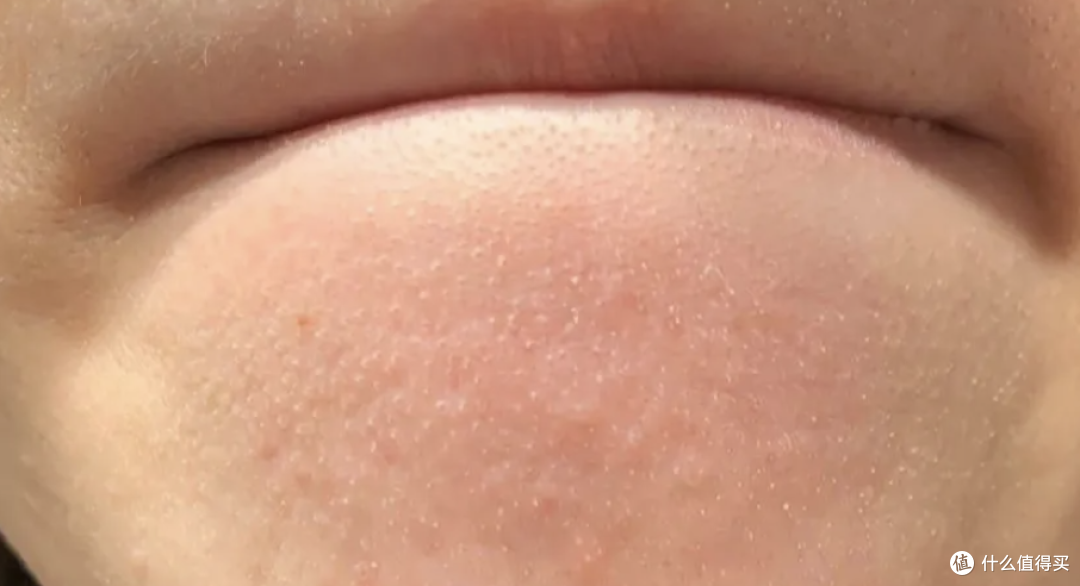 下巴上那层刺刺的小颗粒是啥?真不是闭口,别再上手抠了!