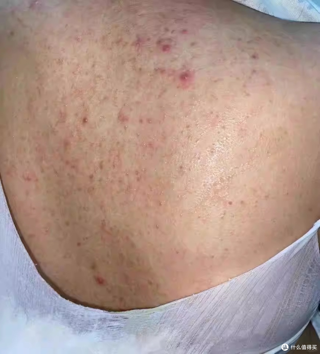 后背痘越抠越多还留疤?先分清是"痘"还是"菌",再谈怎么护理!