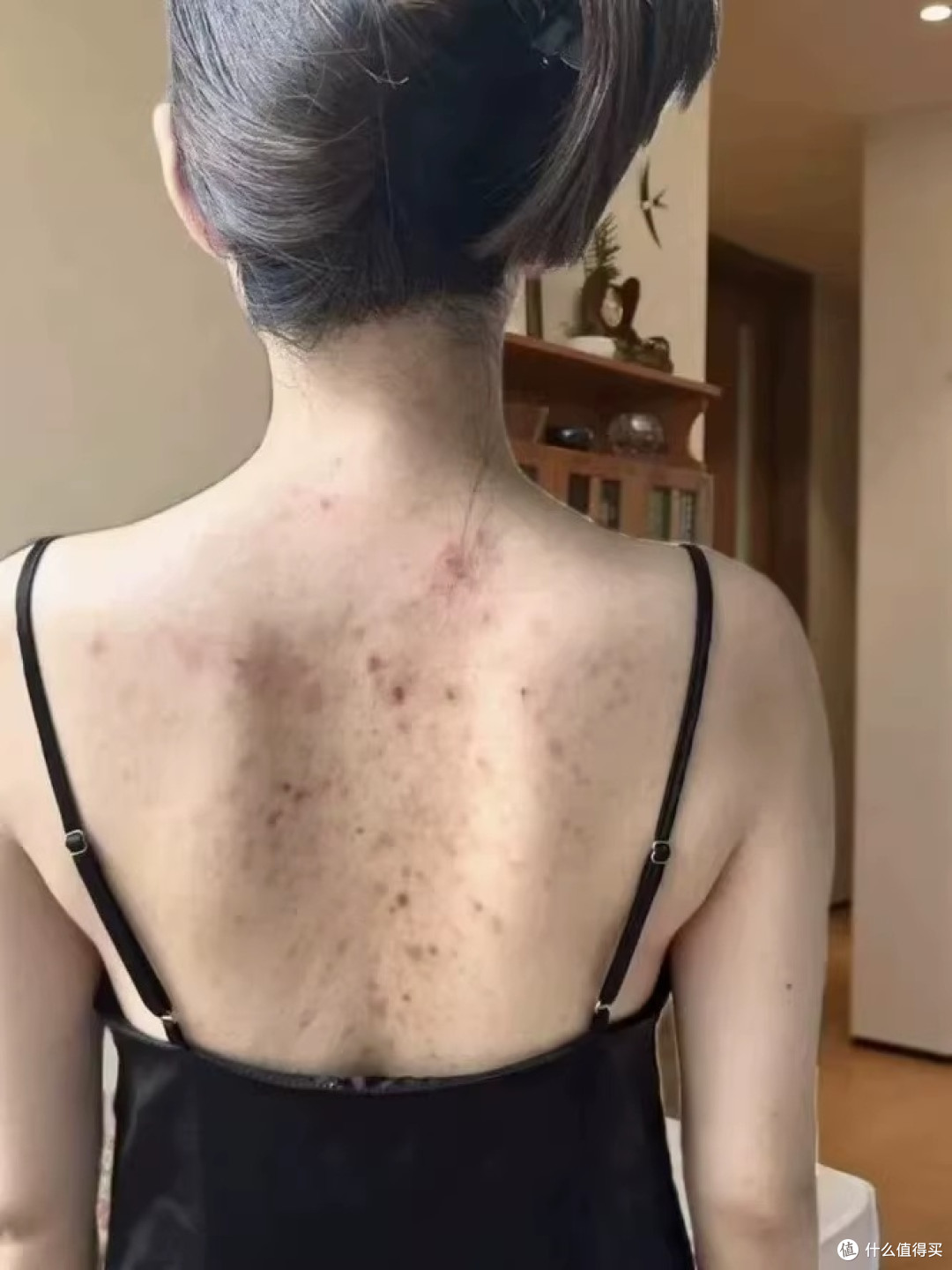 后背痘越抠越多还留疤?先分清是"痘"还是"菌",再谈怎么护理!