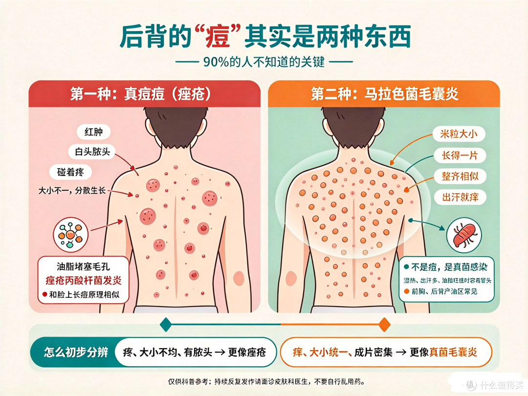 后背痘越抠越多还留疤?先分清是"痘"还是"菌",再谈怎么护理!