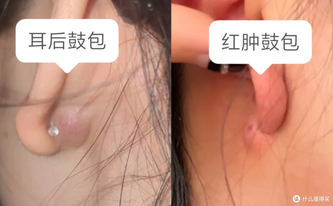 耳朵爱起干皮?刮一下一指甲油?还长火疖子?你可能一直护理错了!