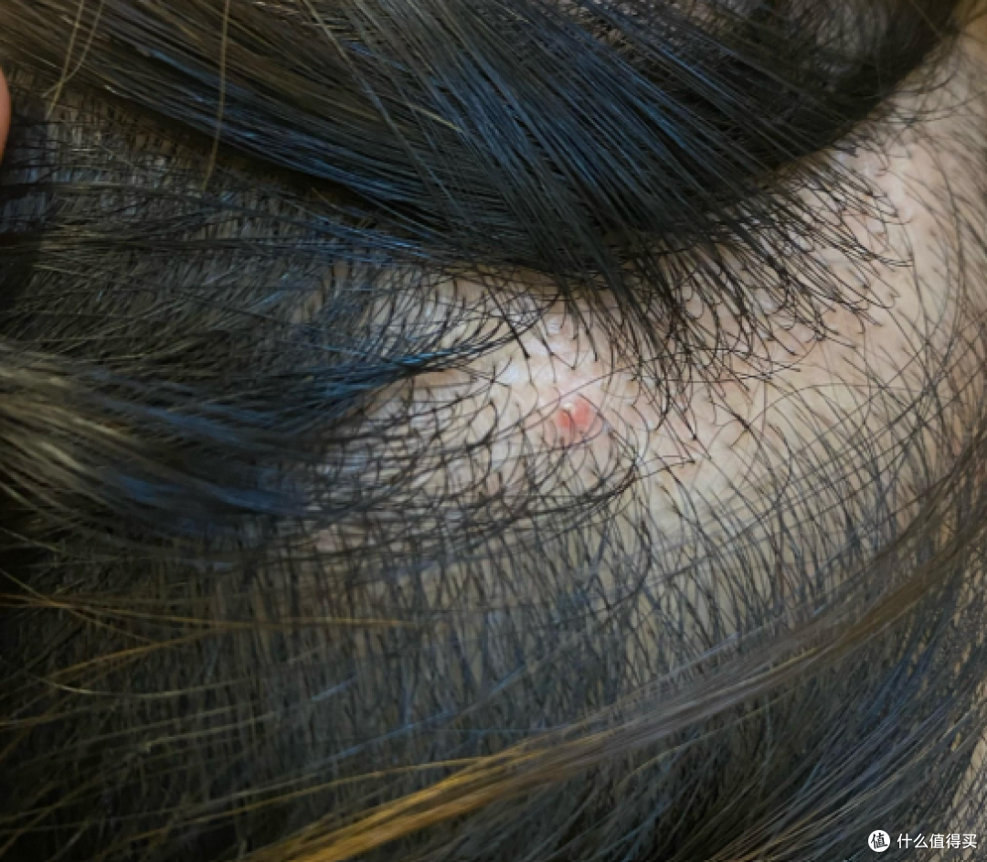 头皮上长「痘」一按就疼?越做越糟的几件事,第一件很多人天天干