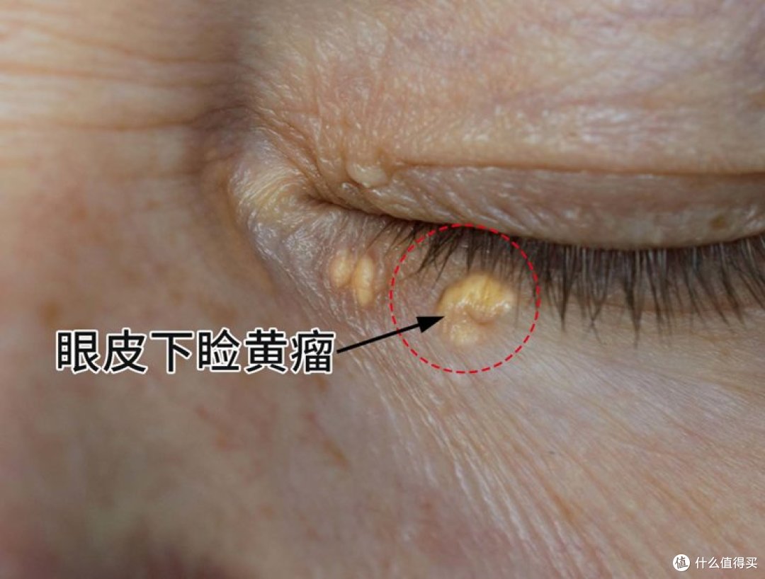 芋头是血脂的克星?医生提醒:高血脂患者多留心,这4物要少碰